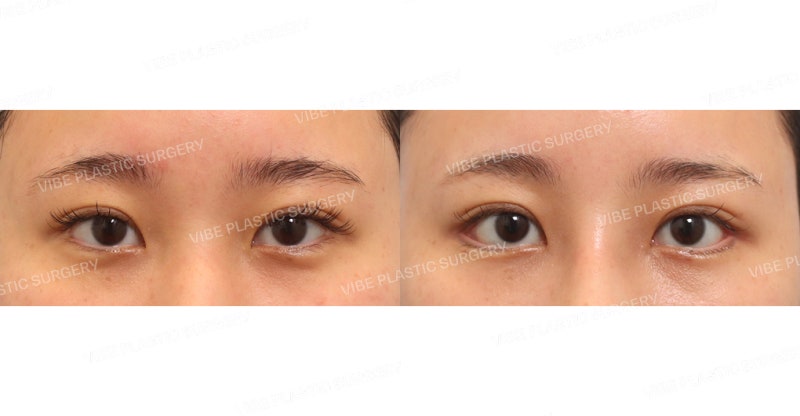 Mango-Teim (เปิดหางตาและปรับองศาตาล่าง, Dual Canthoplasty)