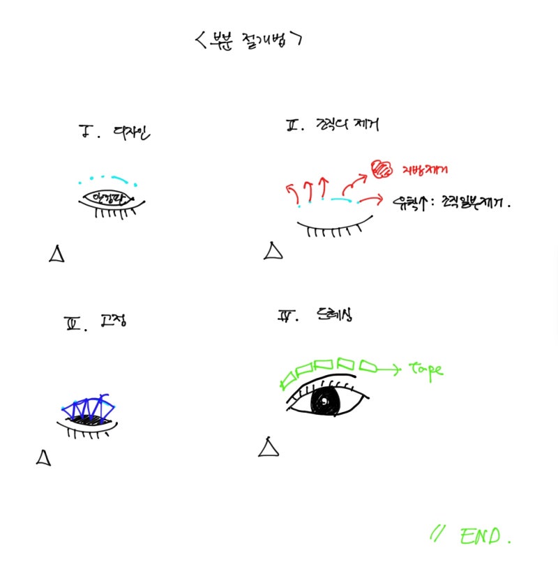 30 Seconds: Partial Incision Double Eyelid Surgery
