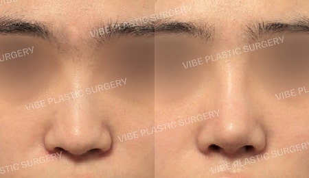 Rhinoplasty for a Low Bridge and Tip