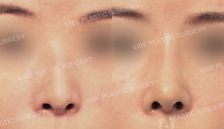 Contracted Nose, Deviated Nose, and Hump Nose (Revision Surgery)