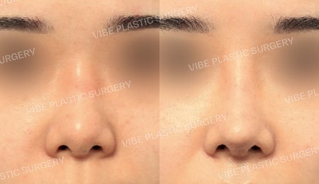 จมูกมีฮัมพ์และปลายจมูกหนา (Bulbous Nose)