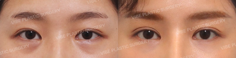 Operasi Kelopak Mata Ganda Metode Insisi (Revisi ke-4), Epicanthoplasty, dan Cangkok Lemak di Bawah Mata