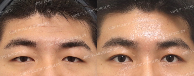 Fix-up 眼型矫正(内视镜额头提升 + 切开法眼型矫正)