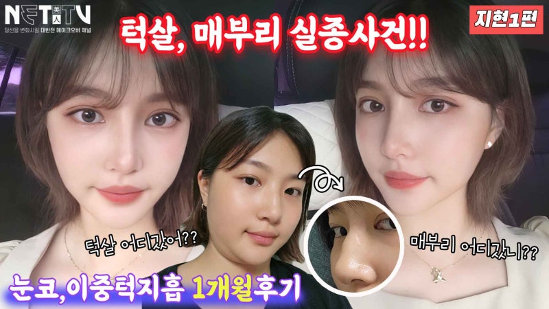 [VIBE Story 4-1] Jihyun’s Eye, Nose, and Fat Grafting Plastic Surgery Review Part 1