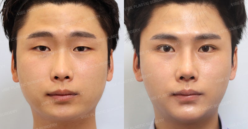 Real Story 6: Male Eye, Nose, and Facial Contouring Transformation