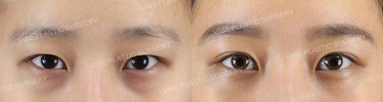Natural Adhesion and Under-Eye Fat Repositioning