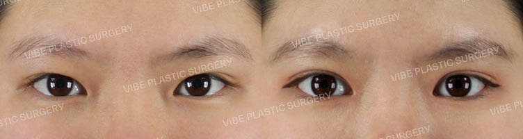 عملية جفن العين بالشق الجزئي وفتح الزاوية الداخلية (Epicanthoplasty)