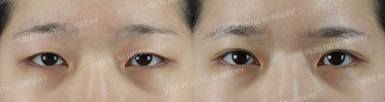 Partial Incision Ptosis Correction