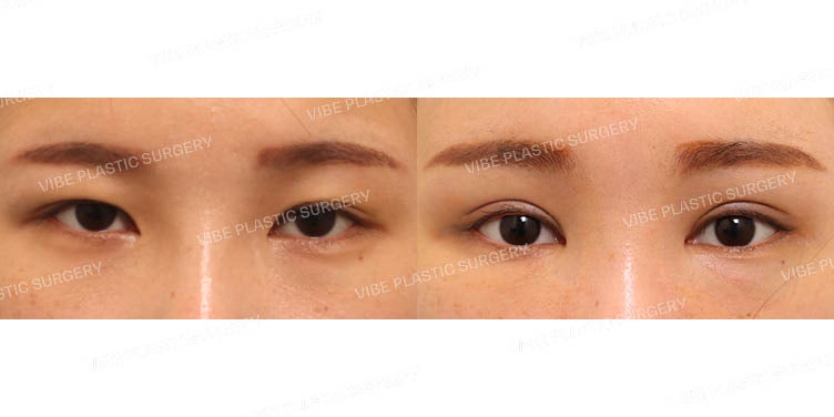 ยกคิ้วผ่านกล้อง (Endoscopic Forehead Lift) + แก้ไขกล้ามเนื้อตาแบบกรีด (ผ่าตัดซ้ำ)