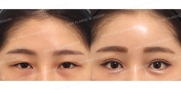 Endoscopic Brow Lift, Incisional Ptosis Correction (Revision), and Mango Canthoplasty (Dual Canthoplasty)