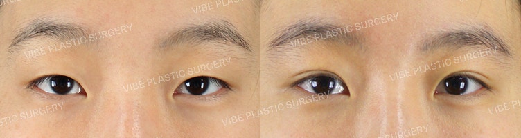Non-Incisional Ptosis Correction