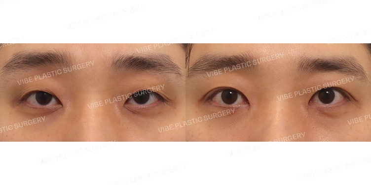 Non-Incisional Ptosis Correction for Men