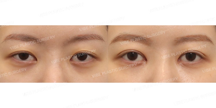 Chỉnh hình sụp mí không xâm lấn (Phẫu thuật lại) và Mở rộng góc mắt trong