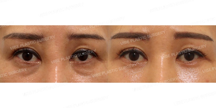 عملية تجميل الجفن السفلي