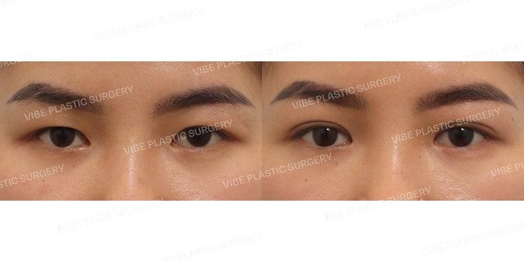 Partial Incision Ptosis Correction
