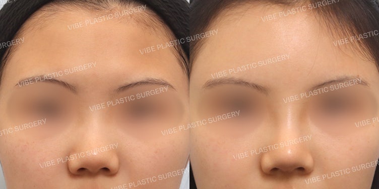 عملية تجميل الأنف المنخفض (+ حقن الدهون في الجبهة)