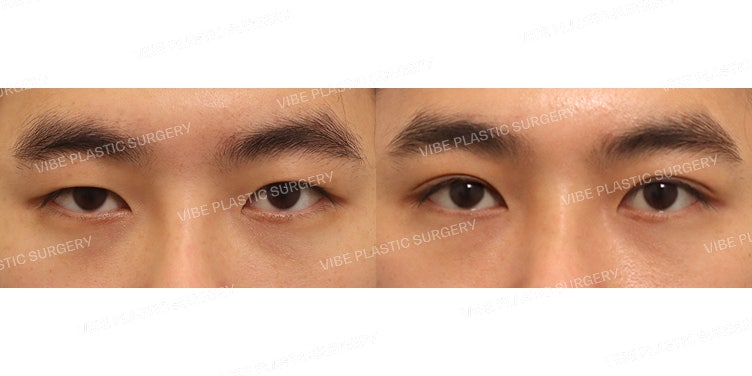 Incisional Ptosis Correction (Revision Surgery)