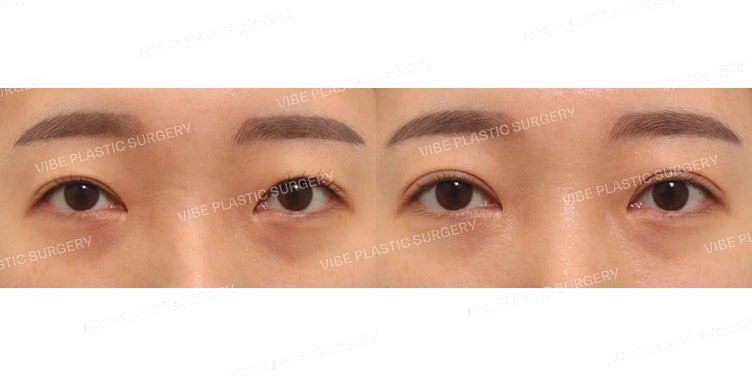 Incisional Ptosis Correction (Revision Surgery)