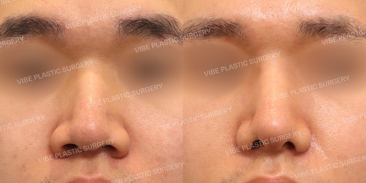 No-Implant, Hump, and Bulbous Nose Rhinoplasty