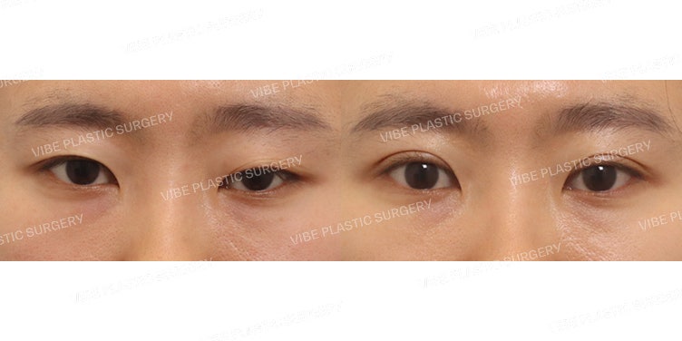 Non-Incisional Ptosis Correction