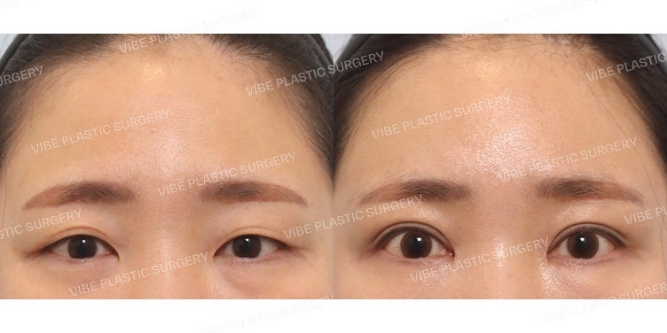 Fix-up ปรับรูปตา (ยกคิ้วผ่านกล้อง + ทำตาสองชั้นแบบกรีดบางส่วน)