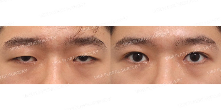 男性眼部整形(部分切开眼型矫正、开内眼角)