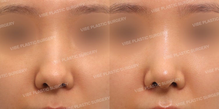 عملية تجميل الأنف بدون غرسات (الأنف المعقوف والأنف الطويل)