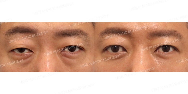 중년 남자 눈성형 (절개 눈매교정, 눈밑 지방 재배치)
