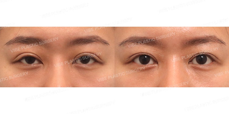 Chỉnh sửa sụp mi bằng phương pháp mổ hở (Phẫu thuật lại lần thứ 4, khắc phục mắt sưng bụp)