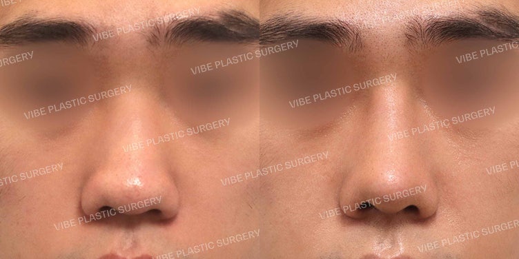 Male Rhinoplasty (Low Bridge, Hump, and Bulbous Nose Correction)