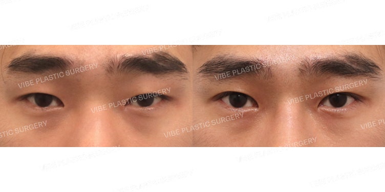 男性眼部整形(自然粘连法)