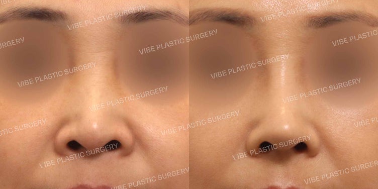 Alar Rim Lowering (Nostril Reduction)