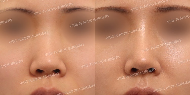 Rhinoplasty for a Low Nose Bridge