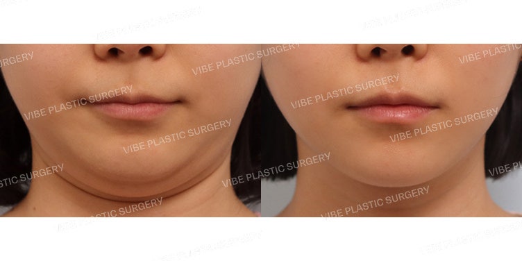 Ultrasonic Liposuction (Double Chin, Jawline)