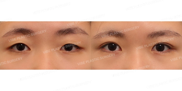 การปรับกล้ามเนื้อตาแบบไม่กรีด (Non-incisional Ptosis Correction)