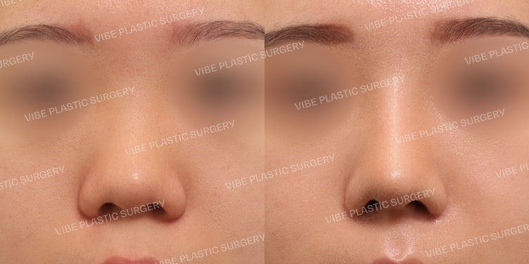 Short Nose and Bulbous Nose Correction