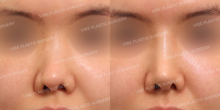 แก้จมูกเบี้ยว (กระดูกอ่อนซี่โครงตัวเอง) และศัลยกรรมจมูกเพื่อการทำงาน (Functional Rhinoplasty)