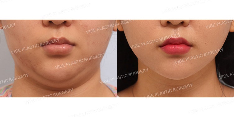 Ultrasound Facial Liposuction