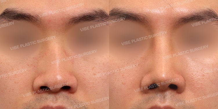 عملية تجميل الأنف للرجال: تصحيح الأنف المعقوف، الأنف المائل، والأنف الوظيفي