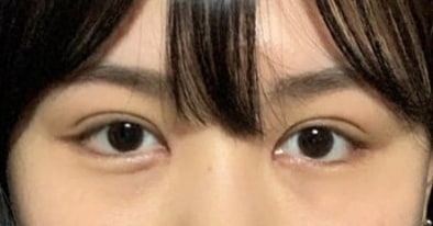 Asymmetry Correction via Non-incisional Ptosis Correction, Epicanthoplasty, and Lateral/Lower Canthoplasty (Mango-Tuck)