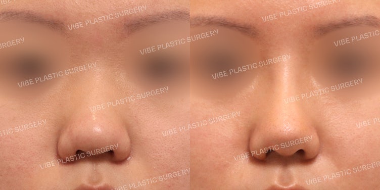 ศัลยกรรมจมูกปลายหนา (Bulbous Nose) และการแก้ไขแกนกลางจมูก (Columella)