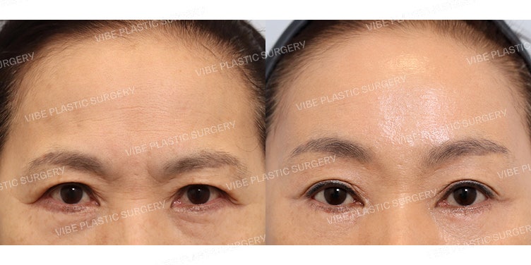 Endoscopic Forehead Lift and Lower Blepharoplasty Revision