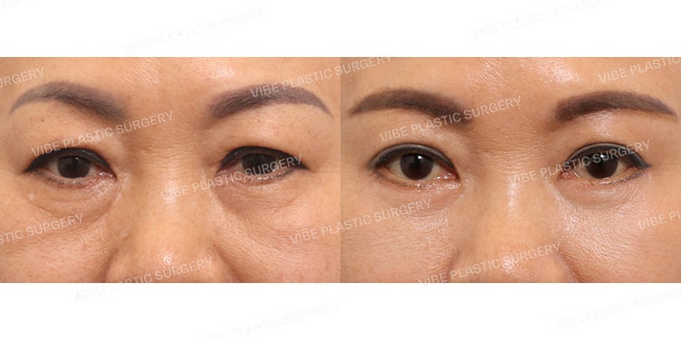 ศัลยกรรมดวงตาสำหรับวัยกลางคน (การยกคิ้ว Subbrow Lift และการผ่าตัดตาล่าง)