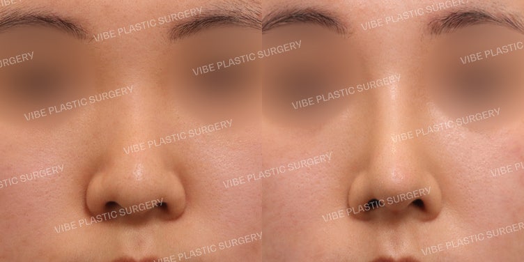 Bulbous Nose Rhinoplasty