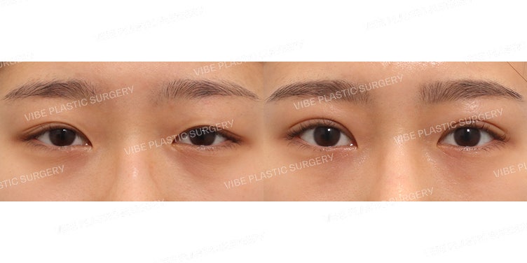 Chỉnh sửa mí mắt bằng phương pháp cắt một phần