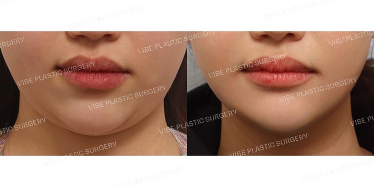 การดูดไขมันด้วยคลื่นเสียงความถี่สูง (LipoSound)