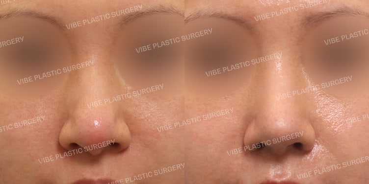 Operasi Revisi Hidung Bulat (Bulbous Nose), Tanpa Implan