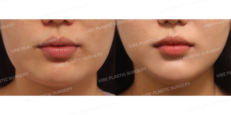 LipoSound Facial Liposuction