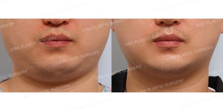 LipoSound Facial Liposuction