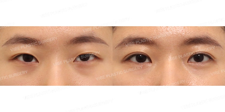 切开法眼提肌修复手术